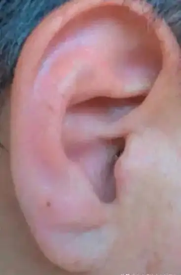 关爱健康 | frank征,亦称耳垂皱褶征