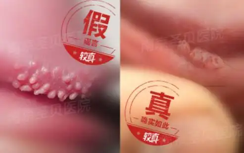 男性假疣真疣图片对比女性假性湿疣,又叫绒毛状小阴唇,它主要是发生在