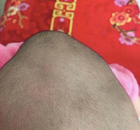 新生儿头皮水肿,头皮血肿,一字之差,哪种是操作不当引起的?