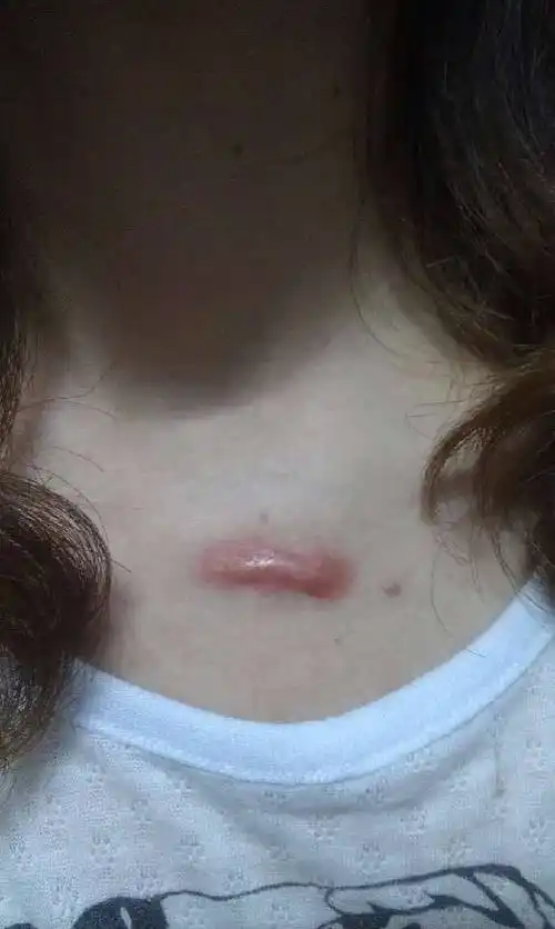 范围超过皮肤损伤边界,向周围正常皮肤浸润生长(与增生性瘢痕相鉴别)1