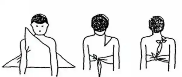 面部包扎法①单侧面部包扎法:将三角巾对折双层,一手将顶角压在伤员健