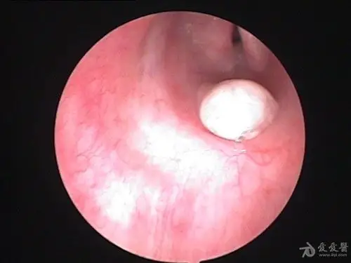 脓痰在气管里的状态,与我们平常见到的不大一样