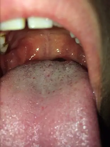 我舌头上这层白的是什么啊?