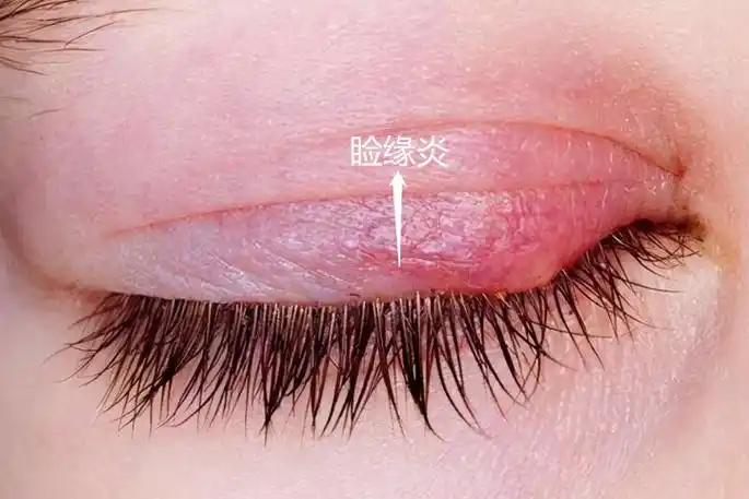 上眼皮发炎红肿图片
