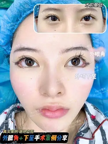 我和医院内签了案例协议,给大家看一下我做完开外眼角_圈子-新氧美容