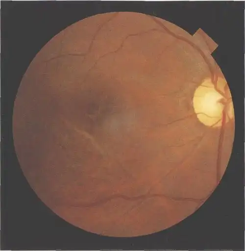图9-36 眼球钝挫伤后黄斑裂洞和脉络膜破裂
