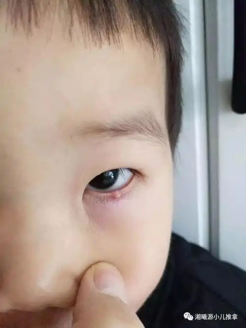 学员真实案例分享—豆豆20天的麦粒肿战斗