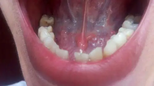 口腔舌头下面长了好多的小水泡