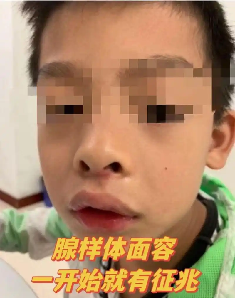 家长你知道吗?腺样体面容在一开始就有征兆了!  1,鼻塞 腺样体肥大会