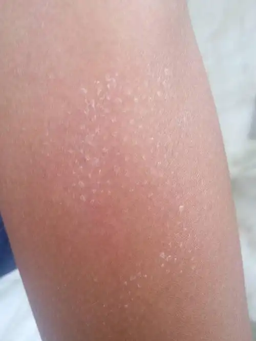 手臂上白色脱皮,虽不严重但丑啊!