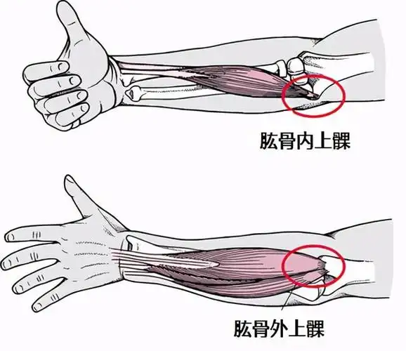 没受伤出现肘关节疼痛可能是网球肘一