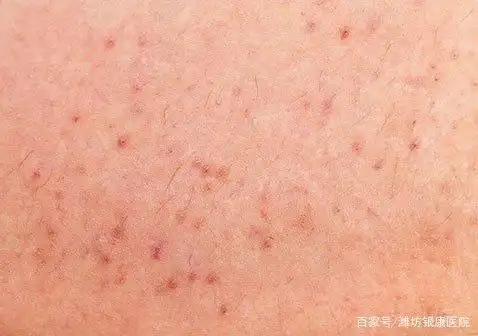 丘疹;同样,每隔一段时间对该部位通风很重要, 以确保皮肤毛孔不出汗