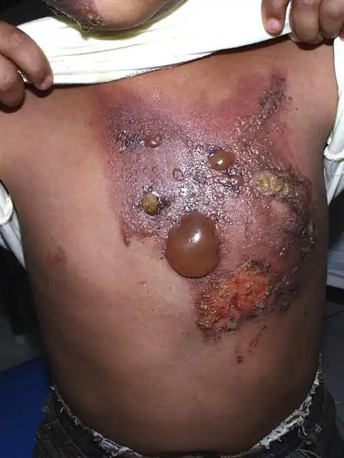 脸烧伤创面好后起红痘又起皮怎么办