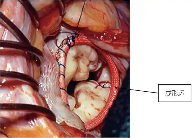 二尖瓣关闭不全哪些患者可以选择做修复