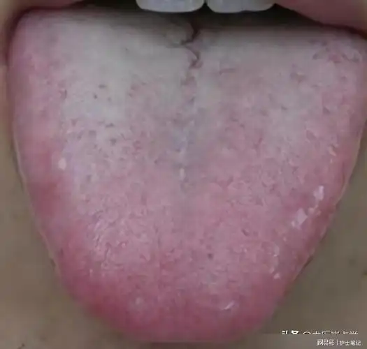 舌头有裂纹,可能不是脾虚,而是这里的问题,快来对照一下