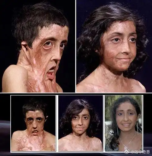 面部严重烧伤的阿富汗女孩在 1 年时间内通过 12 次整容手术恢复正常