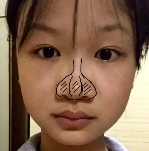 怎么会有怎么形象的蒜头鼻01