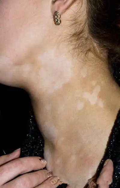 日光性白斑图片4