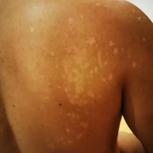 宝宝皮肤上有白色斑点,是怎么回事?