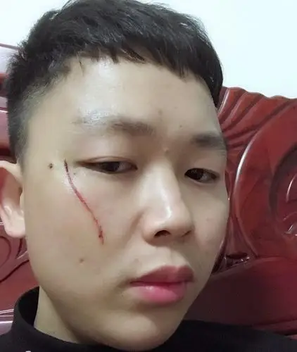 脸上被指甲扣成这样会留疤吗