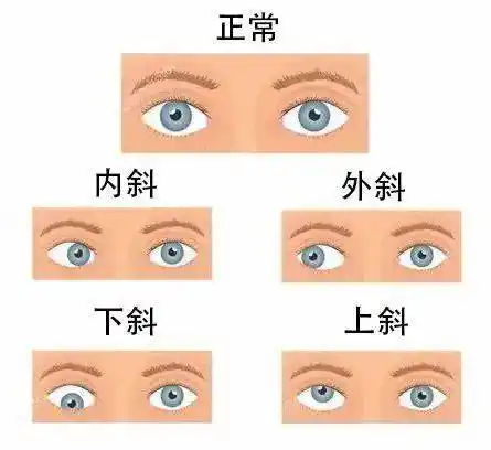 总喜欢斜着眼睛看东西,有问题吗