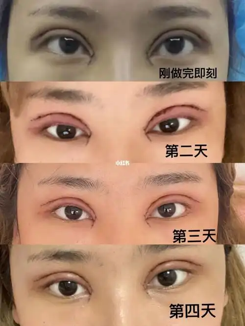 全切双眼皮77开内眼角