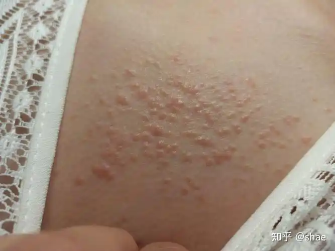 皮肤问题粟丘疹