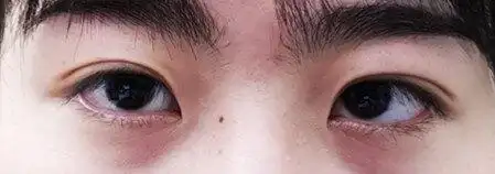 斜视_斜视治疗方式 - 好大夫在线