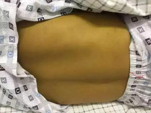 几日之后,何先生开始出现全身皮肤发黄,巩膜发黄,连小便也成了黄褐色