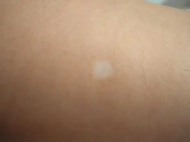 22:33 编辑 ] 沙发回复萍萍很幸运2009-08-21 21:24:36老年性白斑,有