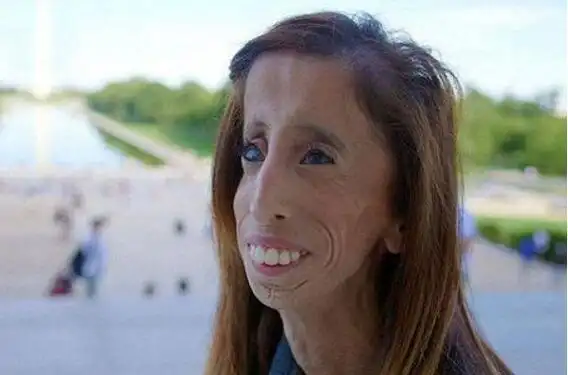 世界上最丑女人(安妮.伍兹)