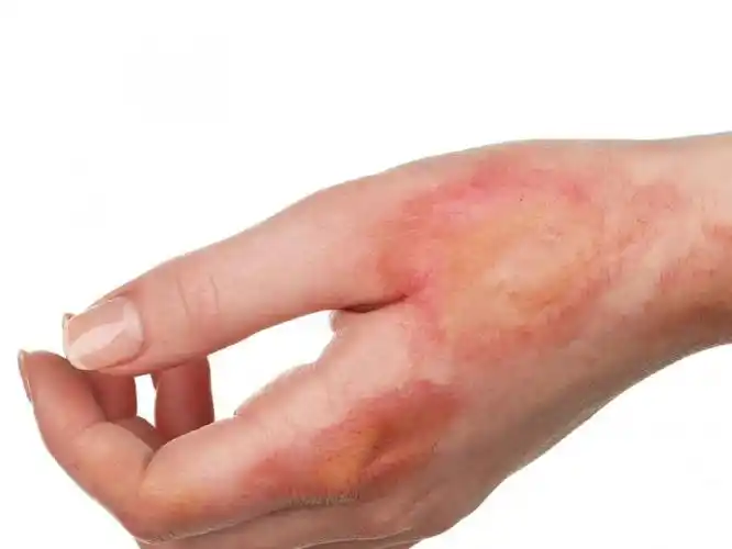 烧伤后要立即用自来水冲,二度以上到医院治疗.