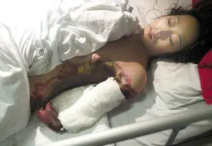 1月28日,因洗澡中毒晕倒后被烧伤手臂的蒋元丽躺在病床上等待做截肢