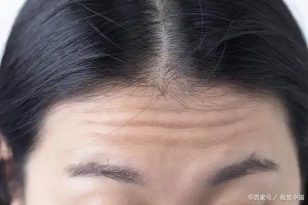 随着年龄增长,即使冻龄美人也避免不了长皱纹,而皱纹有很多种,法令纹