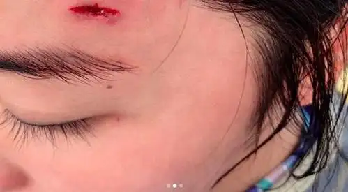 8月2日报道 8月1日晚,阿sa在社交网站上晒出滑水视频和头部受伤照片