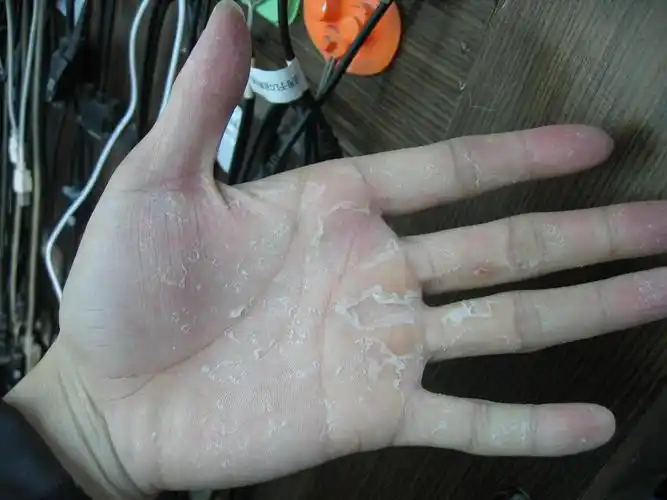 手上起皮,每年春秋换季变温时脱皮非常厉害,从小就有不痛不痒.
