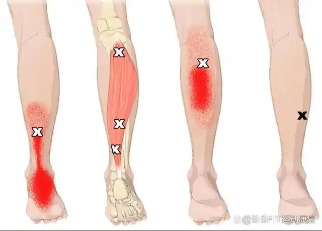 比目鱼肌的功能解剖自我评估与肌筋膜松解