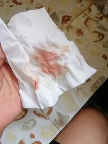 怀孕10周出血怎么办?