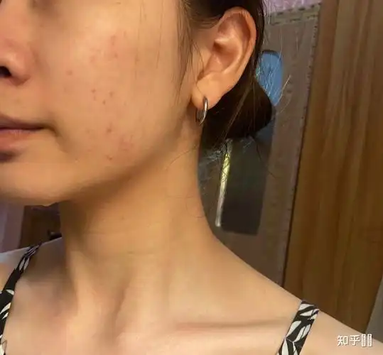 油性痘痘肌用什么洗面奶?