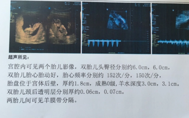 医院检查失误孕妇差点错失双胞胎女儿