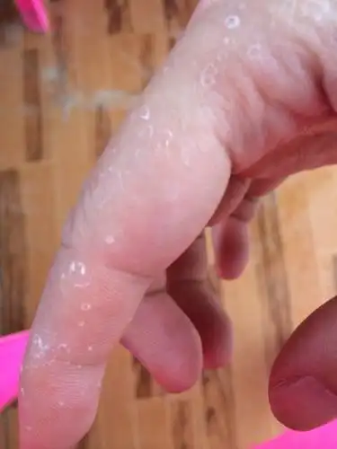 夏天手指掉皮很厉害,一圈一圈地蜕皮 就像图片里的一样,皮肤里感觉有