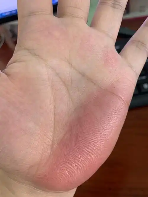 手掌永远有一块发红的地方是为什么啊?