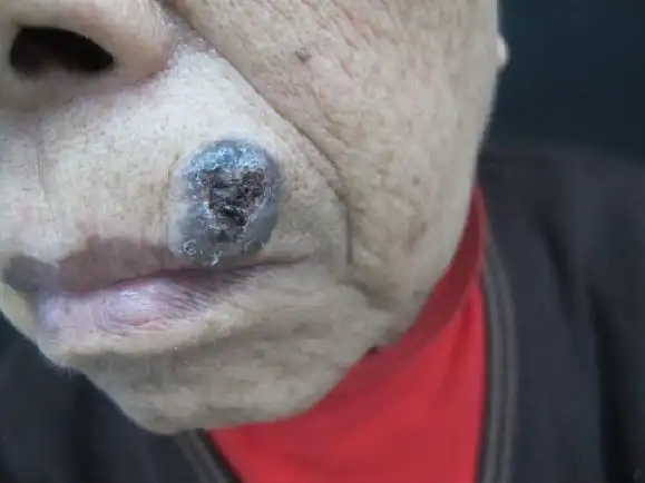皮肤肿瘤之二基底细胞癌