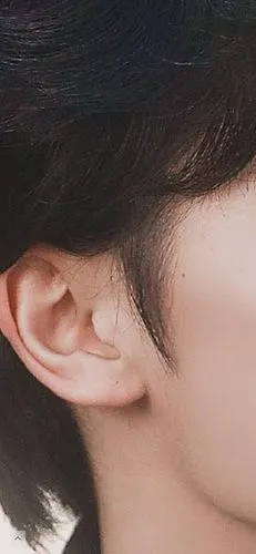 什么程度的耳褶算是耳褶心征呢