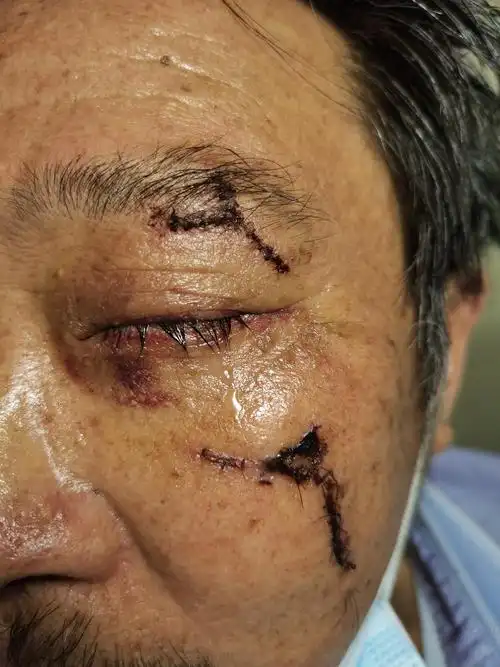 一例车祸致严重的眼球破裂伤_眼球破裂_眼球破裂治疗