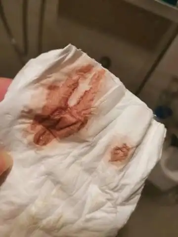 有褐色分泌物,但是没有规律性的疼痛,腰胀,有点来大姨妈的感觉,是不是