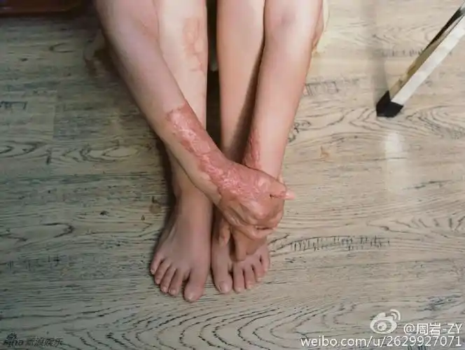 烧伤女孩周岩旧照甜美清纯性格坚强阳光13