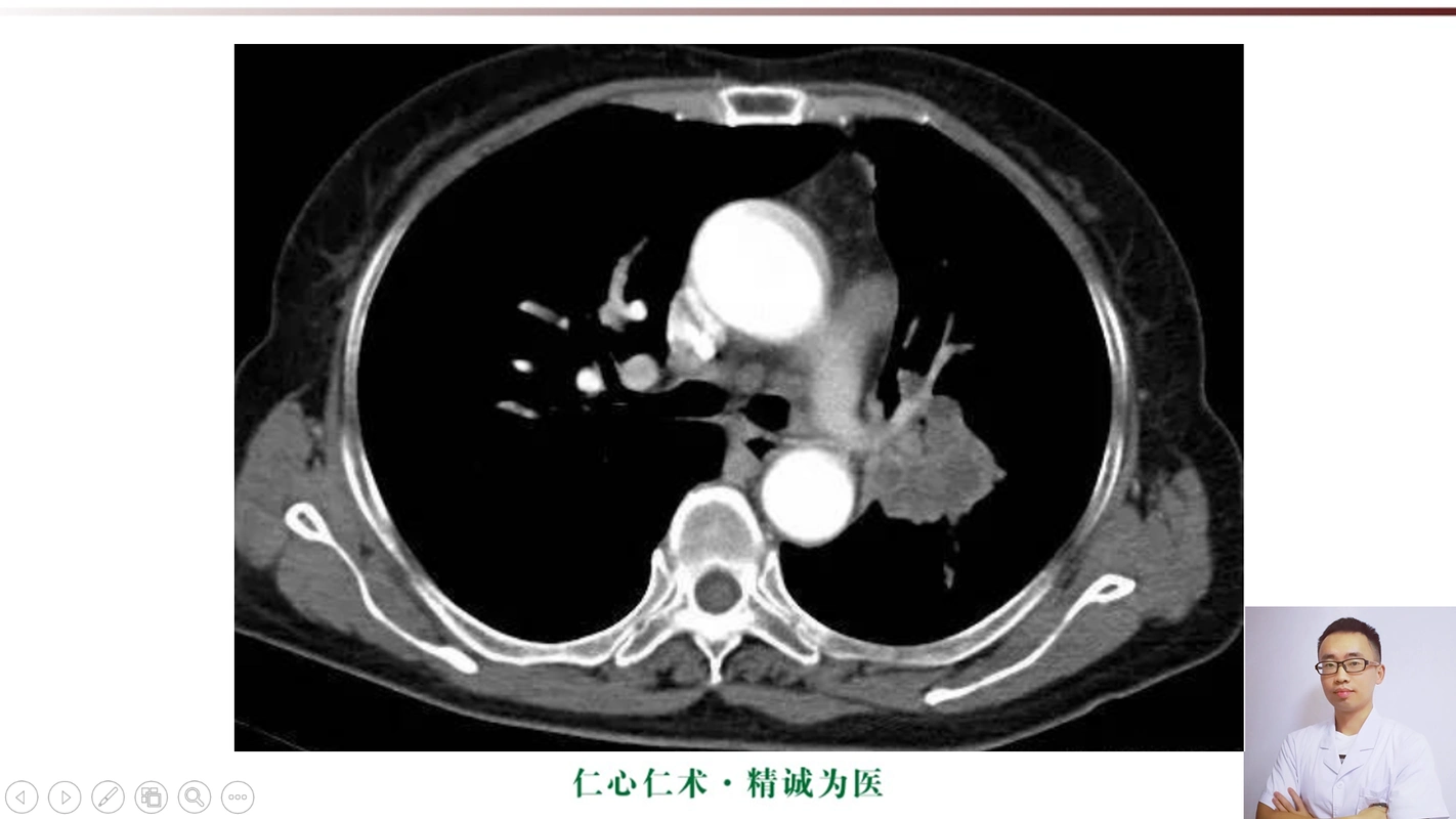 影像基础知识:中央型肺癌ct表现及报告书写!