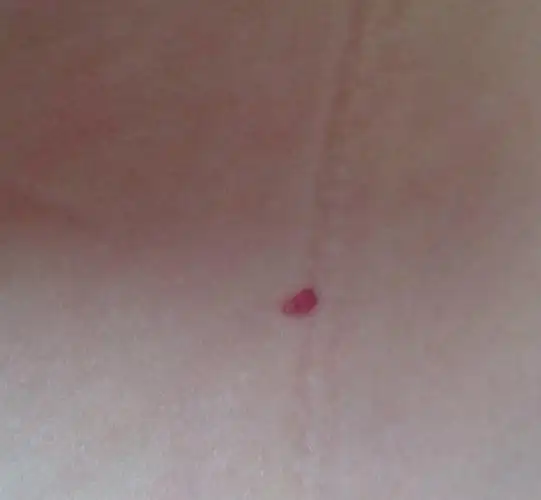 很小的时候就长了这个痣,是朱砂痣吗?长在腰上有什么说法?