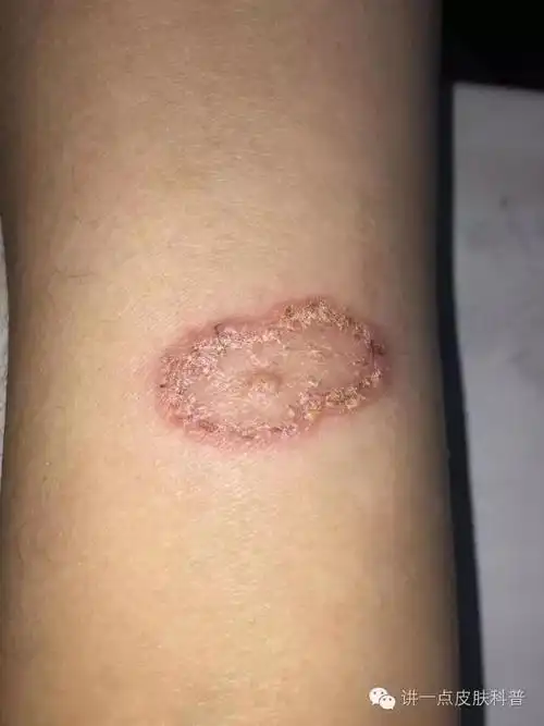 领回来一只猫咪姑娘胳膊出现了圈癣还特痒咋回事呢